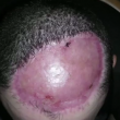 Chris Stoyanov, testa gonfiata per far ricrescere il cuoio capelluto (foto, video) 3