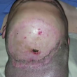 Chris Stoyanov, testa gonfiata per far ricrescere il cuoio capelluto (foto, video)