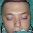 Chris Stoyanov, testa gonfiata per far ricrescere il cuoio capelluto (foto, video) 2