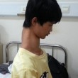 Fu Wengui, il ragazzo dal collo lunghissimo: è nato con 3 vertebre in più 01
