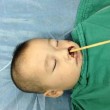 Cina, bimbo di 2 anni si infila bacchetta nel naso, ma gli penetra nel cervello
