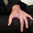 Fb, donna morsa da falsa vedova nera: medici le amputano un dito 06