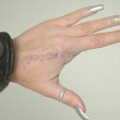 Fb, donna morsa da falsa vedova nera: medici le amputano un dito 03