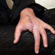 Fb, donna morsa da falsa vedova nera: medici le amputano un dito 01