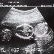 Gb, donna con due uteri dà alla luce tre gemelli01