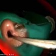 India: ha 50 vermi nel naso che gli stavano mangiando il cervello FOTO 04