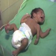 India, bimbo nasce con 3 braccia FOTO: operato con successo