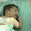 India, bimbo nasce con 3 braccia FOTO: operato con successo 02