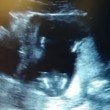 VIDEO YouTube: feto batte le mani a tempo di musica durante ecografia2