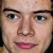 Harry Styles, idolo degli adolescenti, soffre di acne