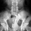 Le radiografie più assurde di incidenti sessuali 06