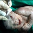 Aleppo, sotto bombe. Bimba nasce con scheggia in testa02