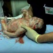 Aleppo, sotto bombe. Bimba nasce con scheggia in testa03