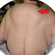 Gobba sulla schiena e tumori sul corpo: colpa dell'alcol