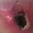 Video YouTube - Melanoma "guarisce" con il balsamo nero 5