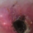 Video YouTube - Melanoma "guarisce" con il balsamo nero 6
