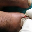 VIDEO YOUTUBE Medico raschia col bisturi unghia infetta e... 3