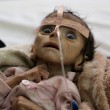 Udai Faisal, bimbo 5 mesi morto di fame in Yemen. FOTO choc01