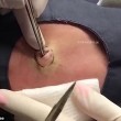 VIDEO YOUTUBE Tumore benigno asportato da braccio02