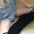 Aimee ha morbo di Crohn: Mi hanno preso muscoli gambe per...02