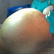 Tumore di 97 chili rimosso da addome donna FOTO