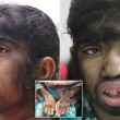 Bangladesh, la "bambina lupo": 12 anni, coperta di peli