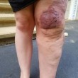 Arianna e la malattia rara: la gamba è tre volte più grande del normale 02