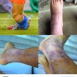Alexis Sanchez, caviglia viola e gamba malridotta dopo la Copa America