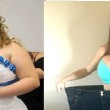 Lyndsey Hoover perde 88 chili: gliene asportano 9 solo di pelle...