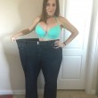 Lyndsey Hoover perde 88 chili: gliene asportano 9 solo di pelle...3