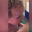YOUTUBE Jasper Allen, 2 anni, ha la peggiore varicella di sempre