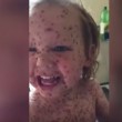 YOUTUBE Jasper Allen, 2 anni, ha la peggiore varicella di sempre5