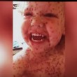 YOUTUBE Jasper Allen, 2 anni, ha la peggiore varicella di sempre3