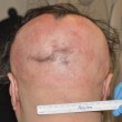 Alopecia, capelli ricrescono 50%: farmaco per artrite è miracoloso2