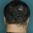 Alopecia, capelli ricrescono 50%: farmaco per artrite è miracoloso3