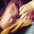 Bambino nel sacco amniotico subito dopo cesareo2