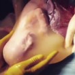 Bambino nel sacco amniotico subito dopo cesareo