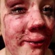 Mamma di 17 anni picchiata di nuovo da sconosciuti:2