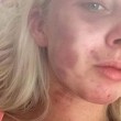 Kelsie Skillen, picchiata dall'ex posta le foto su Fb: "C'è chi lo difende"3
