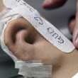 Orecchio paziente ricostruito sul suo braccio