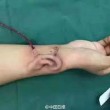 Orecchio paziente ricostruito sul suo braccio