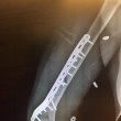 Sci. Lindsey Vonn, addio Coppa del mondo: la campionessa Usa si è rotta un braccio 4