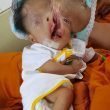 Bambina nata cieca, senza cranio, col labbro leporino, è islamica, la cura un monaco buddista