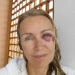 Licia Colò mostra l'occhio nero su Facebook: "Sono caduta sullo skateboard di mia figlia"