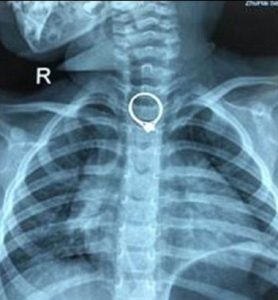 L'anello nell'esofago della bambina