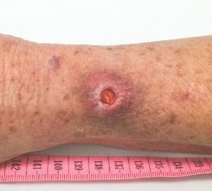 Ulcera carnivora (di Buruli): in Australia siamo all'epidemia. Un batterio divora la pelle