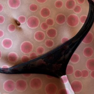 Sifilide e gonorrea triplicate a Milano... la gente pensa non esistano più