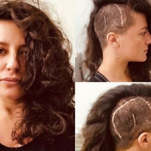 Clio Evans, moglie di Lele Spedicato, mostra la cicatrice in testa FOTO Instagram