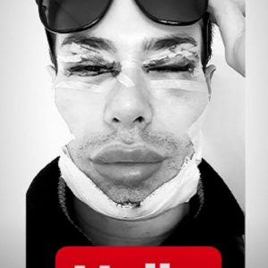 Angelo Sanzio, il "Ken Umano" è irriconoscibile dopo l'ultima operazione (foto Instagram)