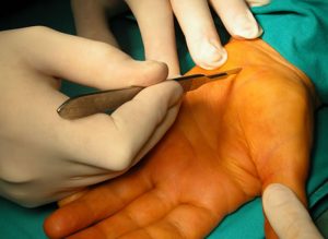 Torino, tetraplegico recupera uso delle mani con bypass dei nervi. E' la prima volta in Italia